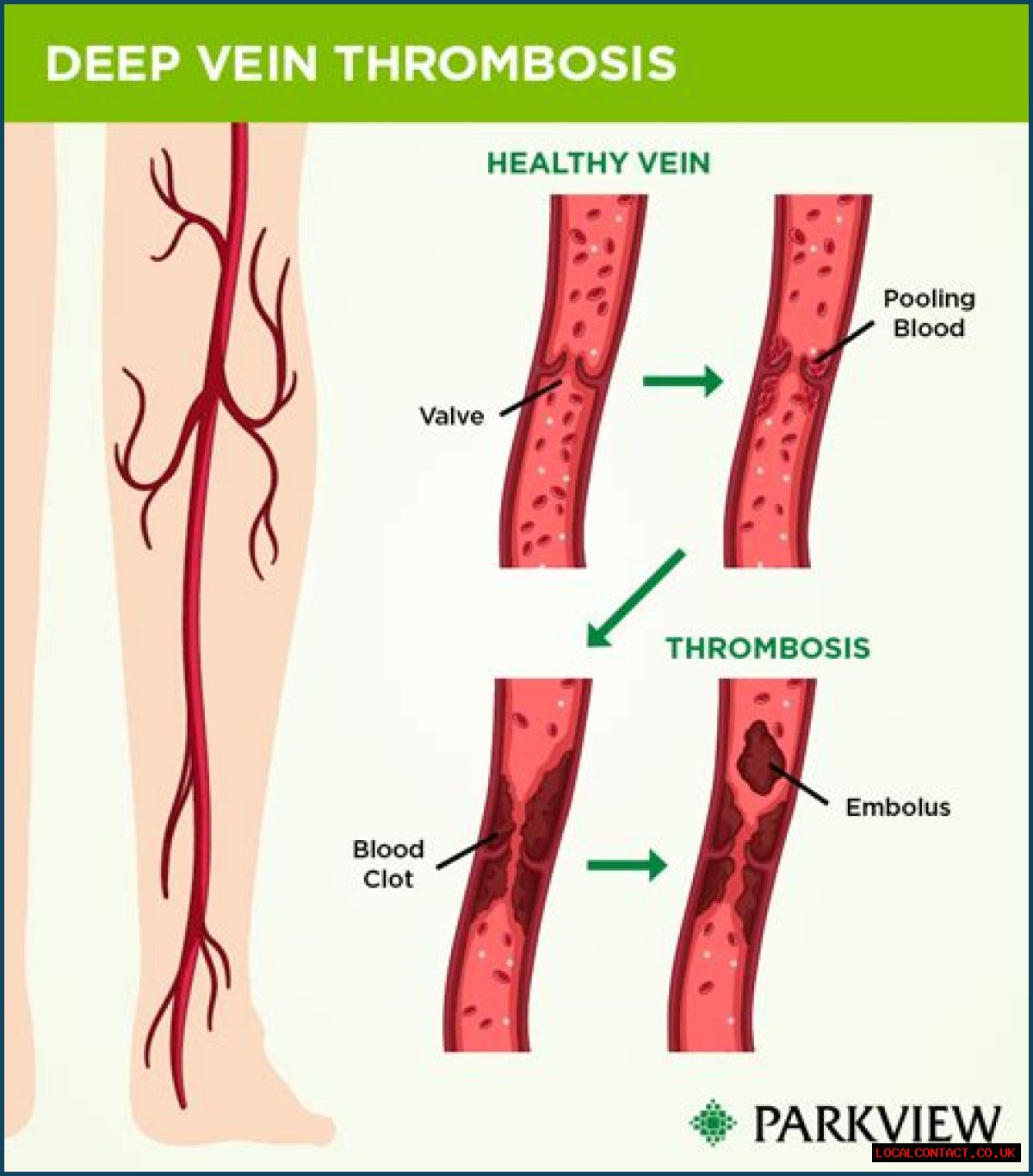 Discover The Exact ICD Code For Deep Vein Thrombosis (DVT)