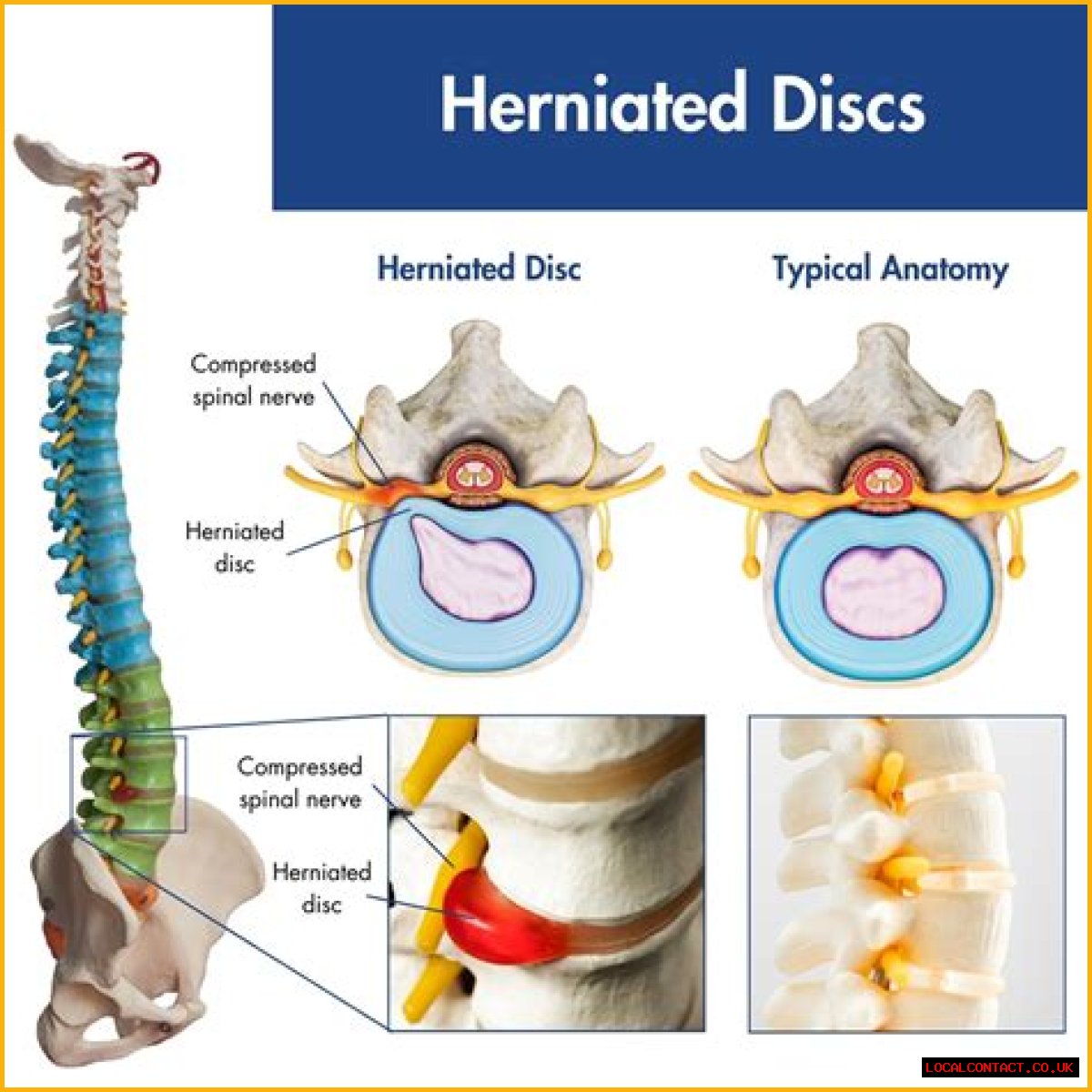 Is herniated disc painful?
