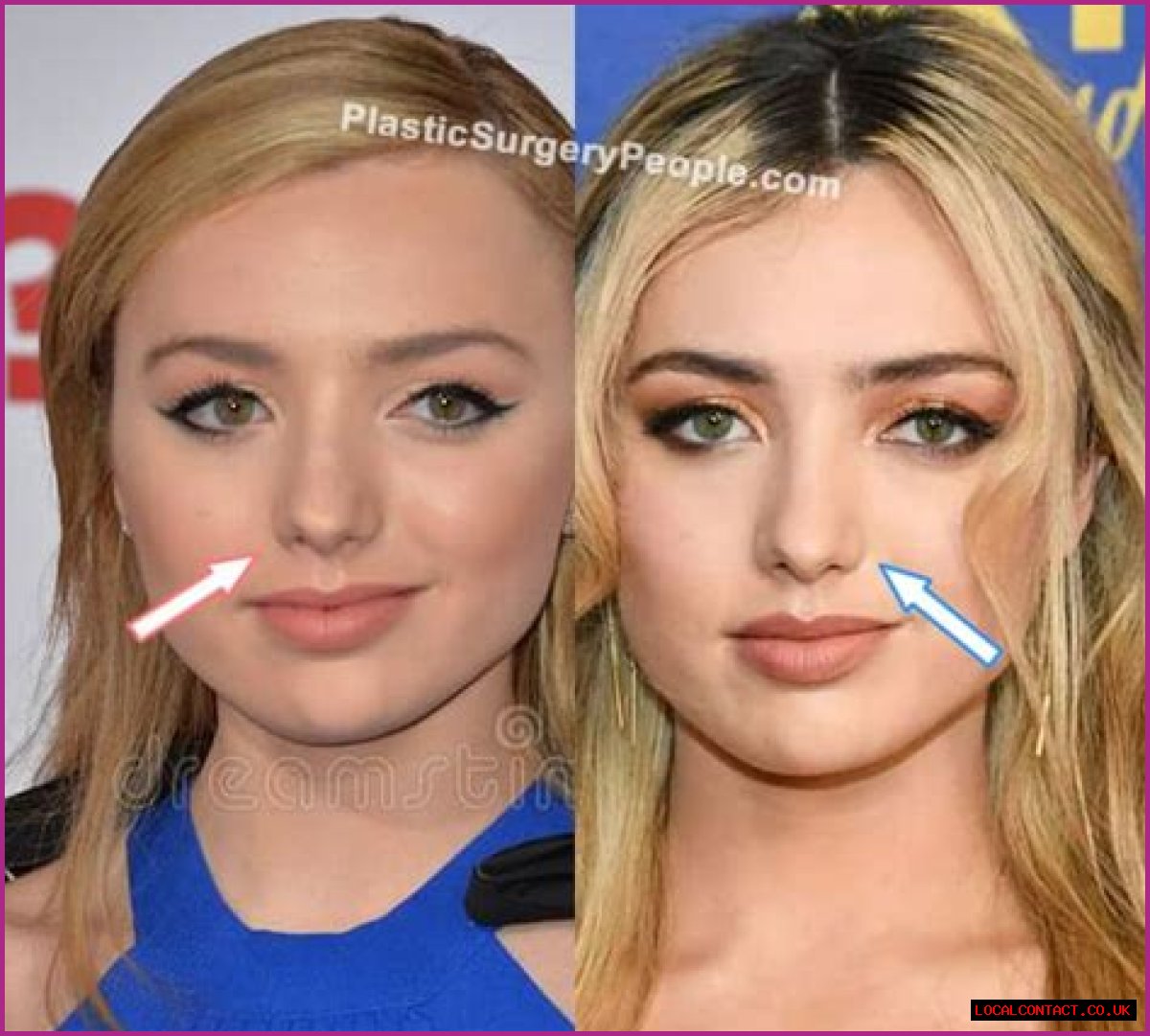 Peyton List Plastic Surgery Before and After